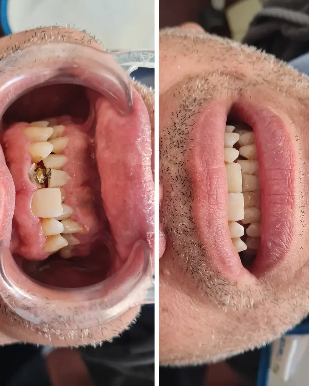 restauracion de dientes bogota